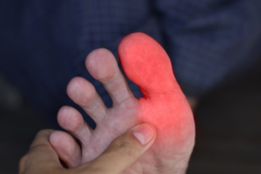 Podiatric Insights Into Sesamoiditis Treatment